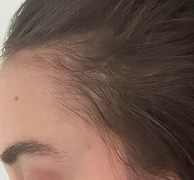 The same customer hairline after consistent use